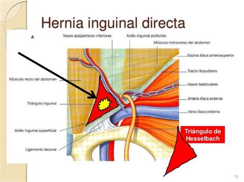 hernia inguinal directa